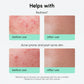 Redness Soothing Azelaic Acid Serum